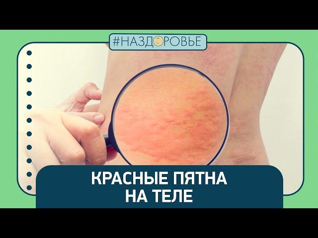 #НАЗДОРОВЬЕ: красные пятна на теле