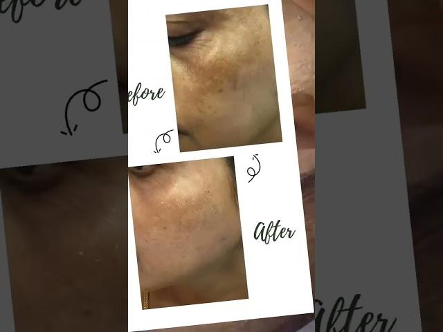 Cosmelan Peel Treatment