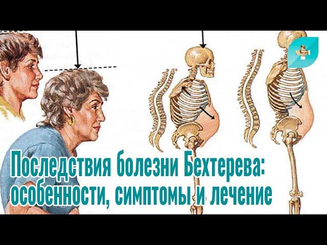 Последствия болезни Бехтерева: особенности, симптомы и лечение