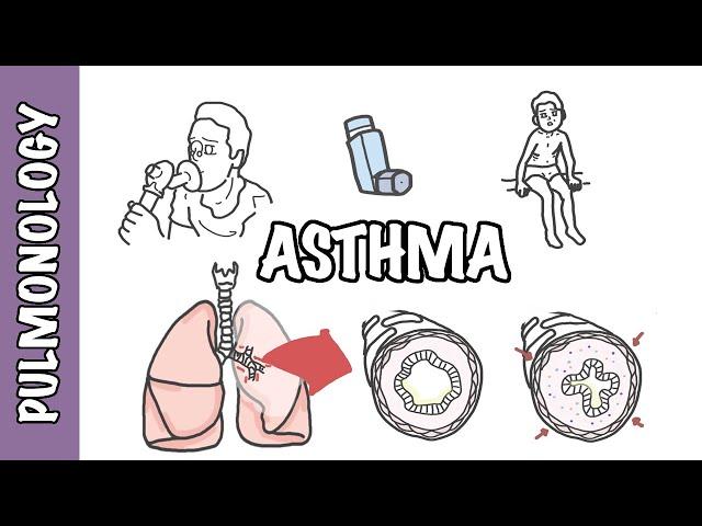 Understanding Asthma - pathophysiology and treatment