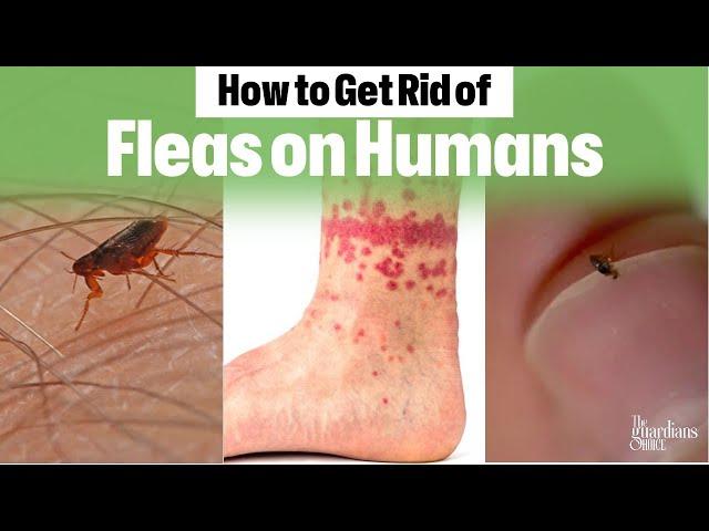 Ultimate Guide: How to Get Rid of Fleas on Humans Fast!