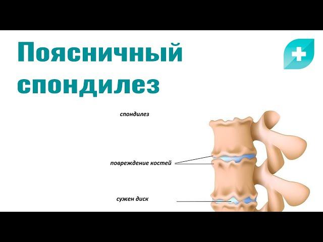 Поясничный спондилез: причины, симптомы и лечение