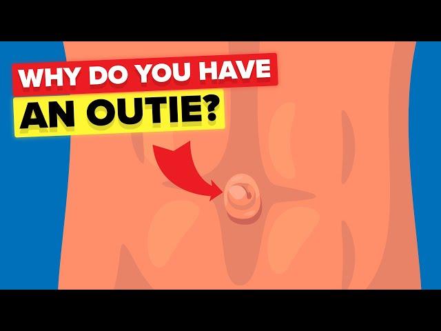 Outie Belly Button - Why Do Some People Have It?