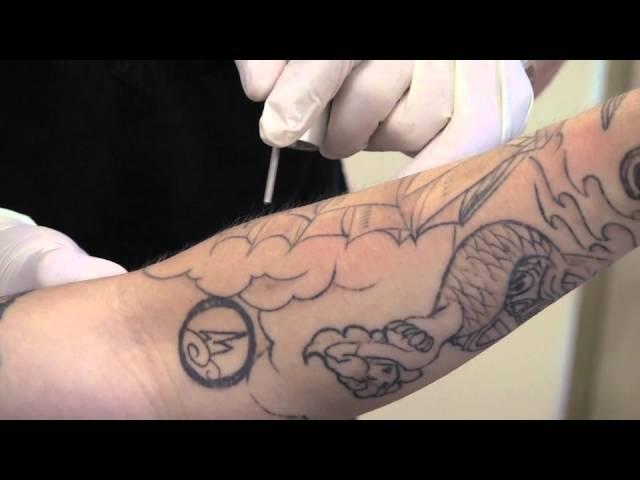 Laser Tattoo Removal Demonstration by Dr. P. Alexander Ataii, M.D.