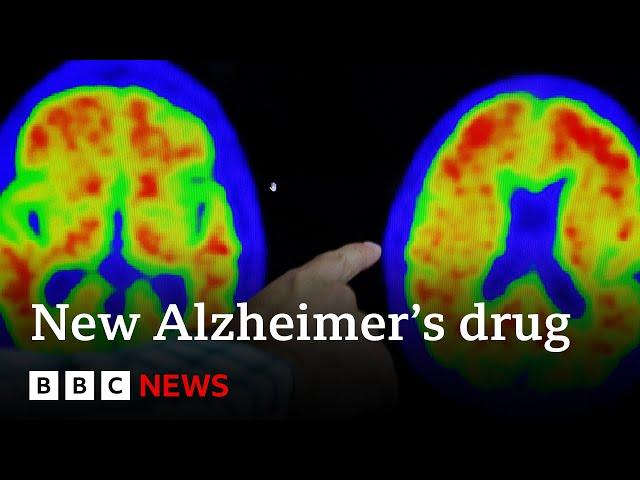 New drug brings hope to end Alzheimer's - BBC News