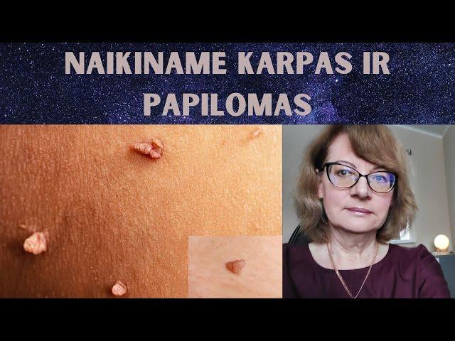 Sveikata | Naikiname karpas ir papilomas