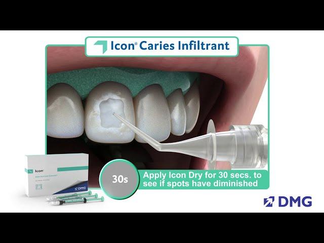 Icon Smooth Surface Caries Infiltrant, Quick Guide