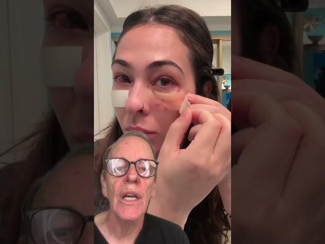 Step By Step Recovery from Eyelid Surgery