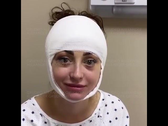 Подтяжка бровей и височный лифтинг
