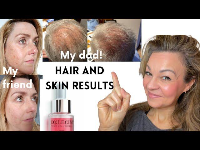 My 79-yr-old Dad's Surprise Hair Regrowth with Calecim Professional!