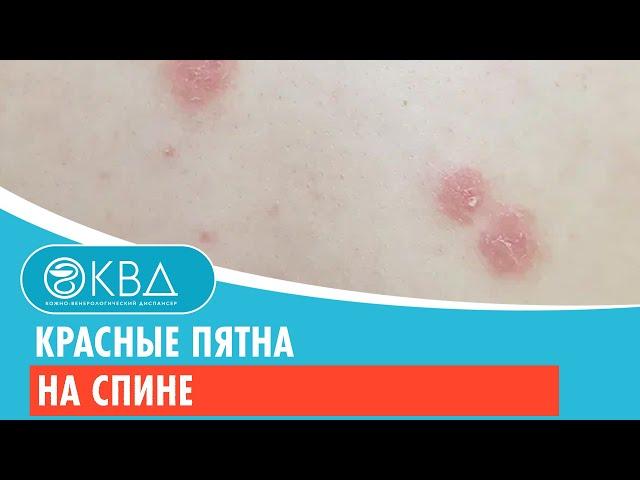  Красные пятна на спине. Клинический случай №307