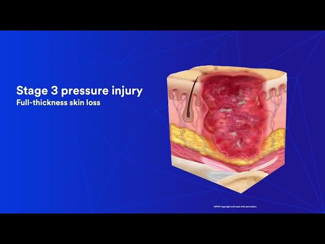 Pressure Injury Education: Chapter 3 Staging