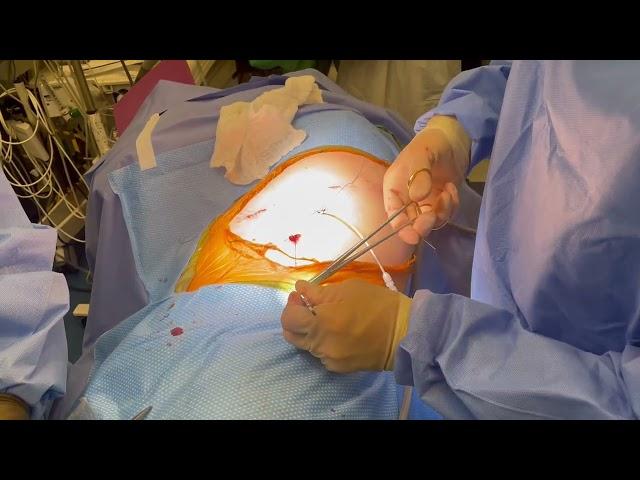 Cerfolio Tips: How Safely Remove Chest Tube in OR with small Air Leak after Lobectomy