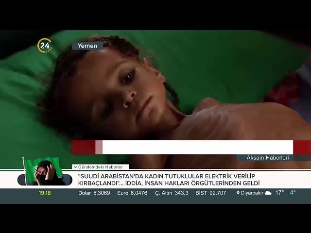 #Yemen'deki iç savaş sırasında 5 yaşın altındaki 85 bin çocuk açlıktan hayatını kaybetti