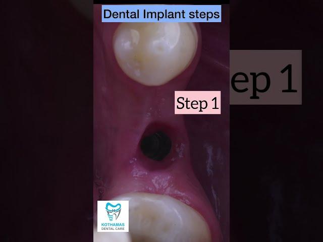 Dental Implant Steps #shorts