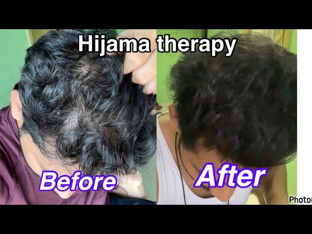 Hijama therapy for hair growth my ￼ experience #educational #hairgrowth