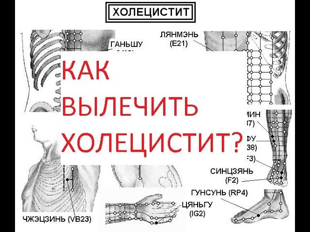 Как вылечить холецистит?