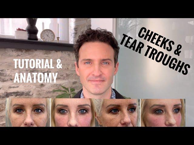 Cheeks & Tear Troughs: Fillers Tutorial (1 of 3 series)