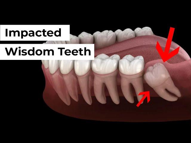 Impacted Wisdom Tooth Removal