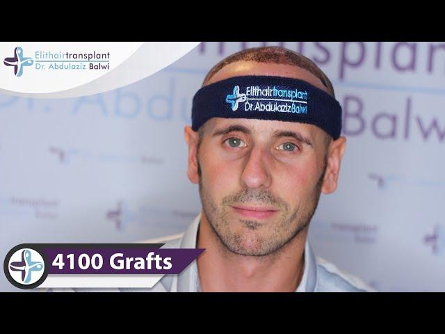 FUE hair transplant turkey | Elithairtransplant istanbul