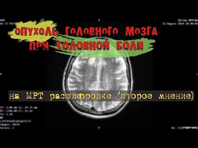 Дисциркуляторная ЭНЦЕФАЛОПАТИЯ fazekas 2 и ОПУХОЛЬ головного мозга на МРТ РАСШИФРОВКЕ второе мнение