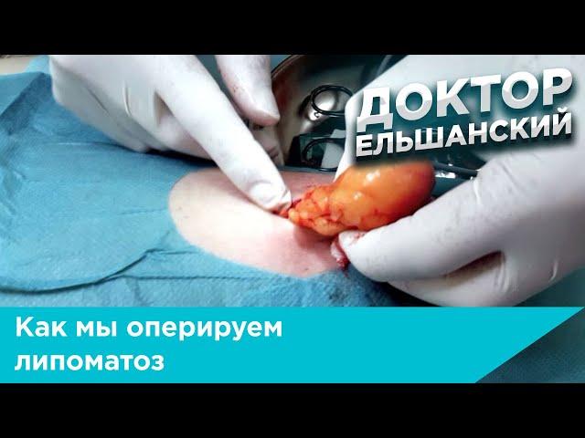 Как мы оперируем липоматоз