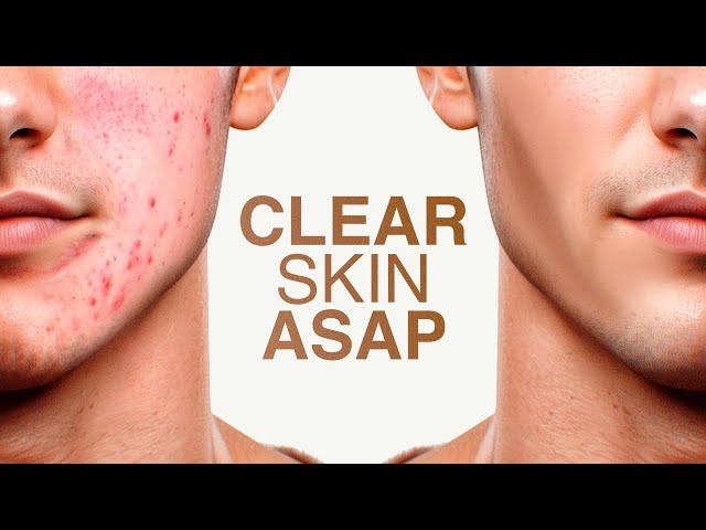 how to get clear skin for guys asap (full guide)