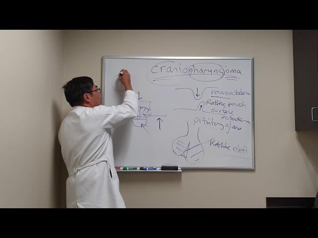 Craniopharyngioma in Neuro ophthalmology