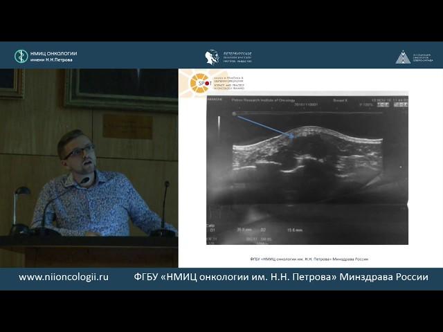 Клинический случай злокачественной филлоидной опухоли молочной железы на фоне беременности