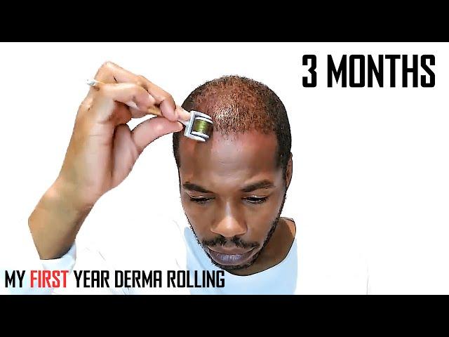 Derma Roller Hair Regrowth Results 3 Months | Month by Month Progress