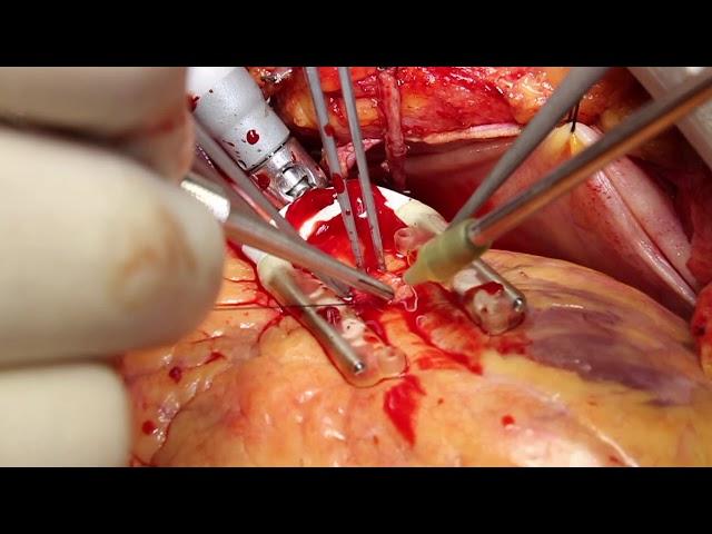 Off-Pump Coronary Artery Bypass With Bilateral Internal Thoracic Arteries in Left Main Disease