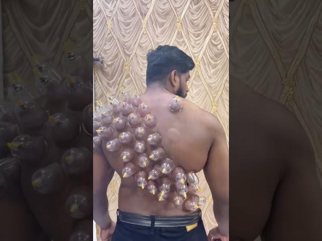 #cuppingtherapy #hijama #cupping #wetcupping #chennai #trending #shorts #shots #shortsvideo #short