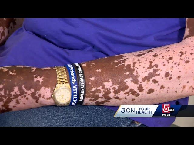 New treatment aims to treat skin pigment loss