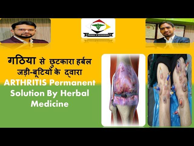 #arthiritis | Arthritis treatment | gathiya ka ilaaj unani