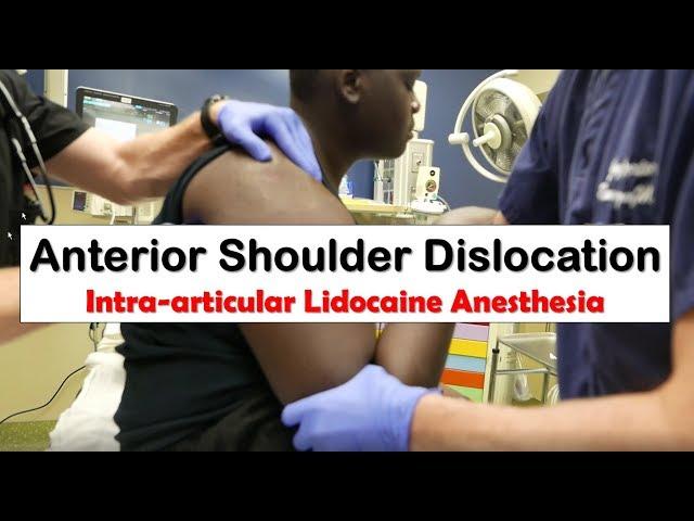 Anterior Shoulder Dislocation and Anesthesia with Intra-articular Lidocaine