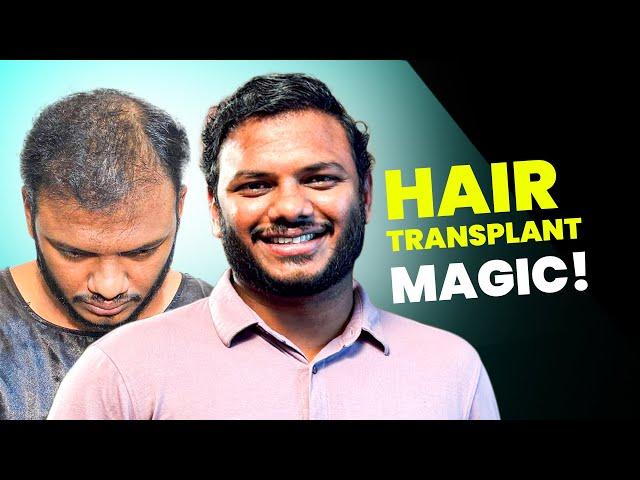 3500 Grafts, 6 Months, Amazing Results!  | Hair Transplant in Hyderabad | New Roots