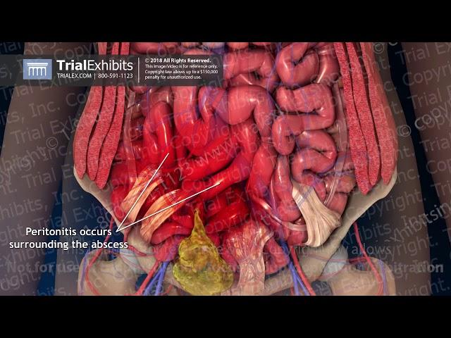 Delayed Post-operative Bowel Perforation with Resulting Septic Shock