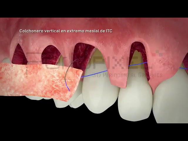 Múltiples recesiones gingivales adyacentes (Dr. Ion Zabalegui) - PerioPixel