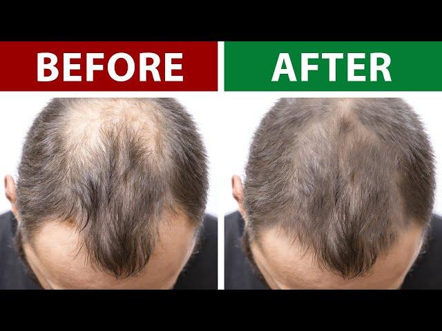 7 Home Remedies to Prevent Hair Loss and Regrow Your Hair