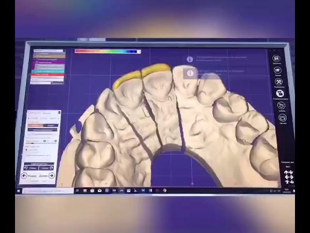 Изготовление 2 виниров  в exocad