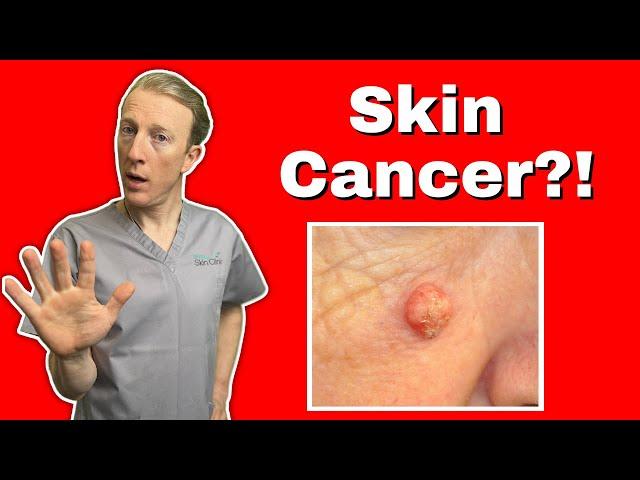 Squamous Cell Skin Cancer (SCC) : What You Need to Know for Early Detection and Treatment