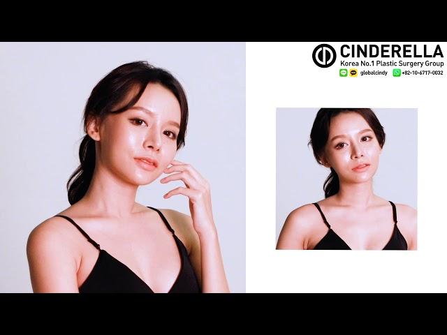 My Plastic Surgery Experience | Cinderella Clinic Korea Plastic Surgery | Sukunya