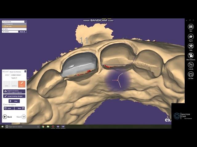 DOCTOR CAD - EXOCAD BASICS - HOW TO DESIGN TWO VENEERS WITHIN 10 MINUTES ON EXOCAD