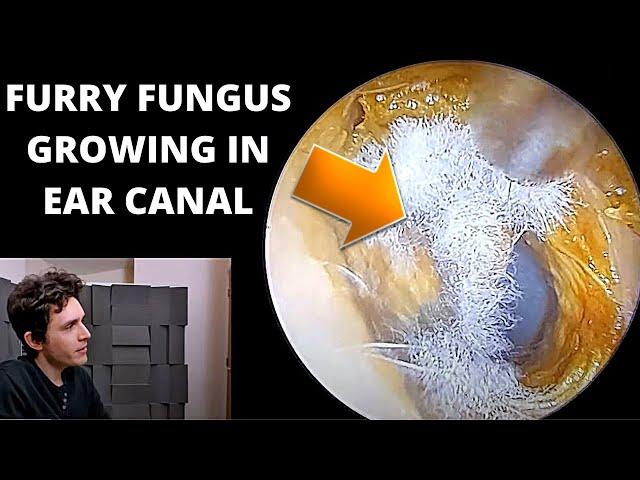 Mystery Furry Fungus Growing in Ear