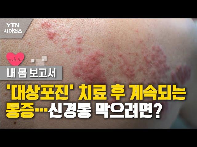 [내 몸 보고서] '대상포진' 치료 후 계속되는 통증…신경통 막으려면? / YTN 사이언스