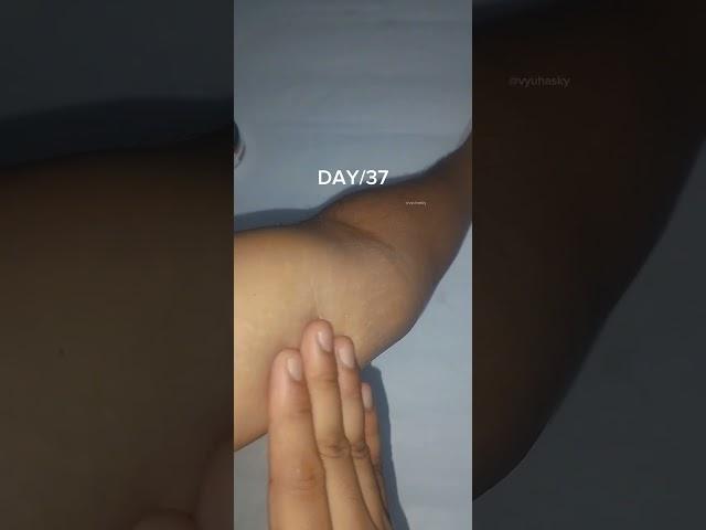 Day/37 of removing strech marks!