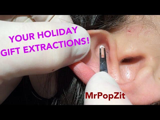 Just in time for the holidays! Acne extractions! Blackheads, whiteheads, nodules. Clearing pores!