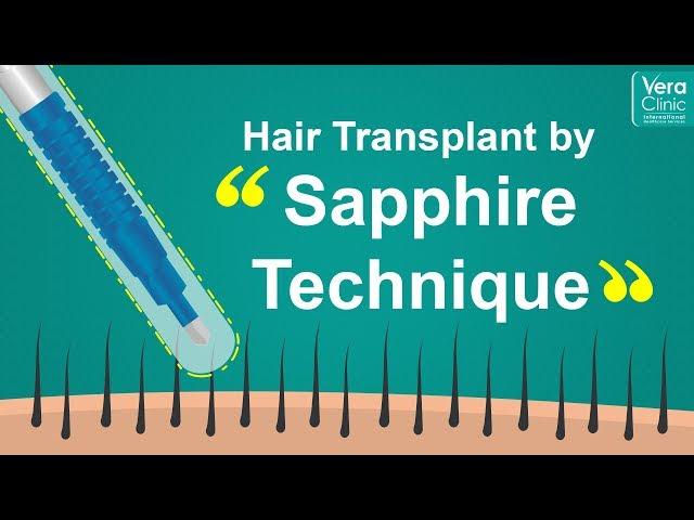 Hair Transplant by Sapphire Technique