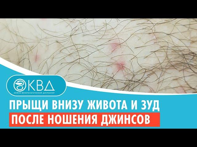  Прыщи внизу живота и зуд после ношения джинсов. Клинический случай №689