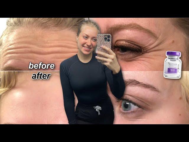 MY FIRST TIME GETTING BOTOX *BEFORE AND AFTER* | sharing my skincare routine